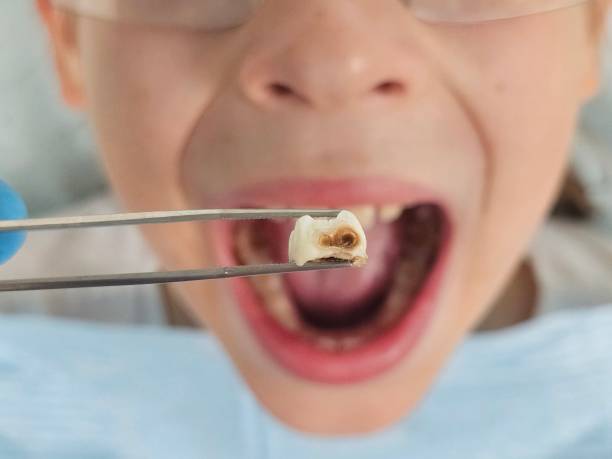 Best Pediatric Emergency Dentist in Newton, MS