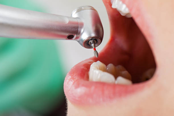 Best Emergency Tooth Extraction in Newton, MS